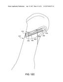 FUSION IMPLANT diagram and image