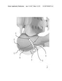 STRESS SHIELDING AND VARIABLE TENSIONING SYSTEM FOR PELVIC FRACTURE     MANAGEMENT OF OSTEOPOROTIC BONES diagram and image