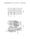 STRESS SHIELDING AND VARIABLE TENSIONING SYSTEM FOR PELVIC FRACTURE     MANAGEMENT OF OSTEOPOROTIC BONES diagram and image