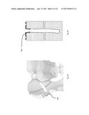 STRESS SHIELDING AND VARIABLE TENSIONING SYSTEM FOR PELVIC FRACTURE     MANAGEMENT OF OSTEOPOROTIC BONES diagram and image