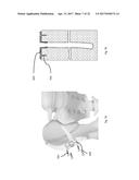 STRESS SHIELDING AND VARIABLE TENSIONING SYSTEM FOR PELVIC FRACTURE     MANAGEMENT OF OSTEOPOROTIC BONES diagram and image