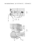 STRESS SHIELDING AND VARIABLE TENSIONING SYSTEM FOR PELVIC FRACTURE     MANAGEMENT OF OSTEOPOROTIC BONES diagram and image