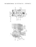 STRESS SHIELDING AND VARIABLE TENSIONING SYSTEM FOR PELVIC FRACTURE     MANAGEMENT OF OSTEOPOROTIC BONES diagram and image