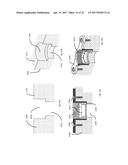 STRESS SHIELDING AND VARIABLE TENSIONING SYSTEM FOR PELVIC FRACTURE     MANAGEMENT OF OSTEOPOROTIC BONES diagram and image