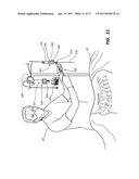 DEVICES FOR PERFORMING A MEDICAL PROCEDURE WITHIN AN APPROPRIATE INTERVAL     AND RELATED SYSTEMS AND METHODS diagram and image