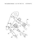 SYSTEM FOR HANDLING AN AUGMENTATION IMPLANT diagram and image