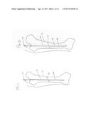 SURGICAL GUIDEWIRE CENTERING DEVICE diagram and image