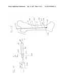 SURGICAL GUIDEWIRE CENTERING DEVICE diagram and image