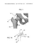 BONE FRACTURE  FIXATION DEVICE WITH TRANSVERSE SET SCREW AND AIMING GUIDE diagram and image