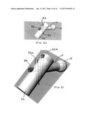 BONE FRACTURE  FIXATION DEVICE WITH TRANSVERSE SET SCREW AND AIMING GUIDE diagram and image