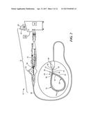 METHOD FOR CLOSURE AND ABLATION OF ATRIAL APPENDAGE diagram and image