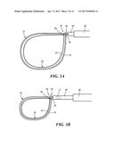 METHOD FOR CLOSURE AND ABLATION OF ATRIAL APPENDAGE diagram and image