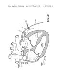 METHOD FOR CLOSURE AND ABLATION OF ATRIAL APPENDAGE diagram and image