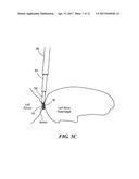 METHOD FOR CLOSURE AND ABLATION OF ATRIAL APPENDAGE diagram and image