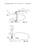 METHOD FOR CLOSURE AND ABLATION OF ATRIAL APPENDAGE diagram and image