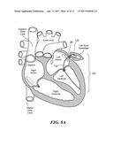 METHOD FOR CLOSURE AND ABLATION OF ATRIAL APPENDAGE diagram and image