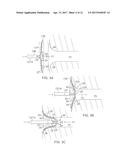 CATHETER WITH MEMBRANED SPINES FOR PULMONARY VEIN ISOLATION diagram and image