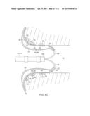 CATHETER WITH MEMBRANED SPINES FOR PULMONARY VEIN ISOLATION diagram and image