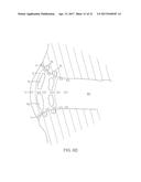 CATHETER WITH MEMBRANED SPINES FOR PULMONARY VEIN ISOLATION diagram and image