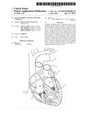 SELF-CENTERING MULTIRAY ABLATION CATHETER diagram and image