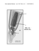 DENTAL SCREWDRIVER diagram and image