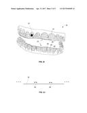 THREE-DIMENSIONAL PRINTED DENTAL APPLIANCES USING LATTICES diagram and image