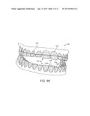 THREE-DIMENSIONAL PRINTED DENTAL APPLIANCES USING SUPPORT STRUCTURES diagram and image