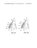 ORTHODONTIC ASSEMBLY diagram and image