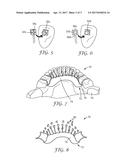 LINGUAL ORTHODONTIC APPLIANCE WITH REMOVABLE SECTION diagram and image