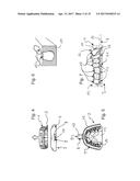 IMPRESSION TRAY, AND METHOD FOR CAPTURING STRUCTURES, ARRANGEMENTS OR     SHAPES, IN PARTICULAR IN THE MOUTH OR HUMAN BODY diagram and image