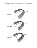 IMPRESSION TRAY, AND METHOD FOR CAPTURING STRUCTURES, ARRANGEMENTS OR     SHAPES, IN PARTICULAR IN THE MOUTH OR HUMAN BODY diagram and image