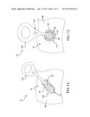MEDICAL DEVICE HAVING REMOVABLE DEPLOYMENT DEVICE AND AFFIXATION ELEMENT diagram and image