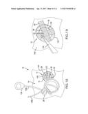 MEDICAL DEVICE HAVING REMOVABLE DEPLOYMENT DEVICE AND AFFIXATION ELEMENT diagram and image