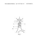 TILTABLE IMPLANTABLE MEDICAL DEVICE diagram and image