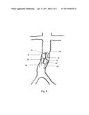 TILTABLE IMPLANTABLE MEDICAL DEVICE diagram and image