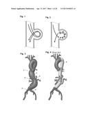 STENT ASSEMBLY FOR THORACOABDOMINAL BIFURCATED ANEURYSM REPAIR diagram and image