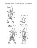 STENT ASSEMBLY FOR THORACOABDOMINAL BIFURCATED ANEURYSM REPAIR diagram and image