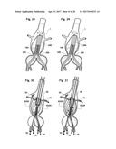 STENT ASSEMBLY FOR THORACOABDOMINAL BIFURCATED ANEURYSM REPAIR diagram and image