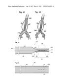 STENT ASSEMBLY FOR THORACOABDOMINAL BIFURCATED ANEURYSM REPAIR diagram and image