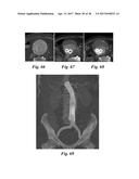 STENT ASSEMBLY FOR THORACOABDOMINAL BIFURCATED ANEURYSM REPAIR diagram and image