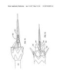 Methods of Self-Aligning Stent Grafts diagram and image