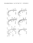 Methods of Self-Aligning Stent Grafts diagram and image