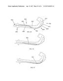 Methods of Self-Aligning Stent Grafts diagram and image