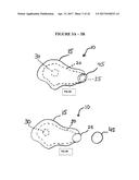 IMPLANT INSERTION DEVICE AND METHOD OF USE THEREOF diagram and image