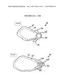 IMPLANT INSERTION DEVICE AND METHOD OF USE THEREOF diagram and image