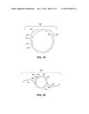 APPARATUS FOR CREATING INCISIONS TO IMPROVE INTRAOCULAR LENS PLACEMENT diagram and image