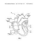 Heart Valves Prostheses and Methods for Percutaneous Heart Valve     Replacement diagram and image