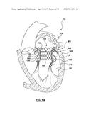 Heart Valves Prostheses and Methods for Percutaneous Heart Valve     Replacement diagram and image