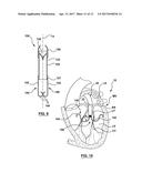 Heart Valves Prostheses and Methods for Percutaneous Heart Valve     Replacement diagram and image