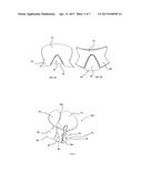 Mitral Valve Assembly diagram and image